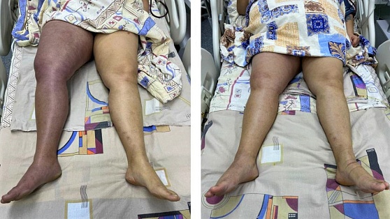 Спасли ногу: в Нижневартовске женщине расщепили тромб