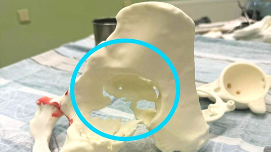 В Сургуте впервые распечатали на 3D-принтере имплант тазовой кости