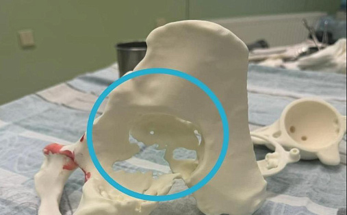 В Сургуте пациенту установили протез, изготовленный на принтере